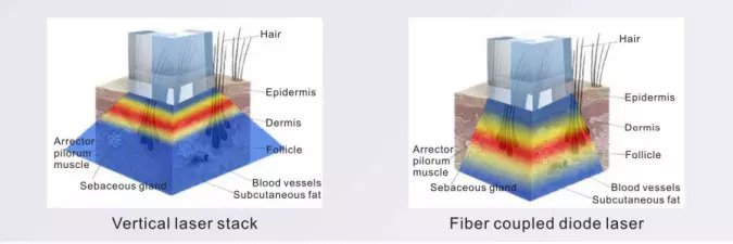 Зоны влияния оптоволоконной диодный лазер SB Fiber